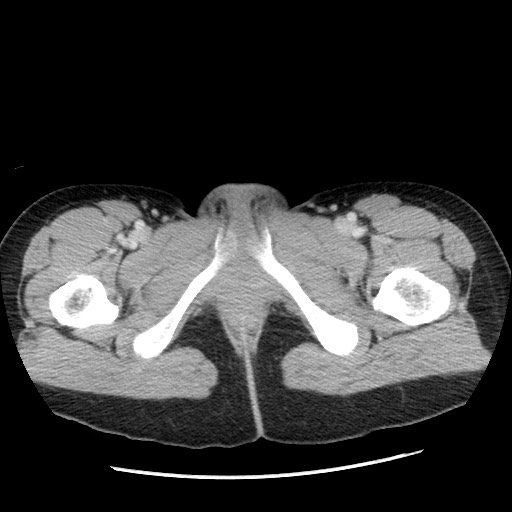 Castleman disease with fibrous pseudotumor in the abdomen (Radiopaedia 77296-89373 A 138).jpg