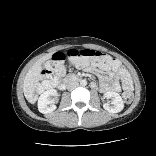 File:Castleman disease with fibrous pseudotumor in the abdomen (Radiopaedia 77296-89373 A 56).jpg
