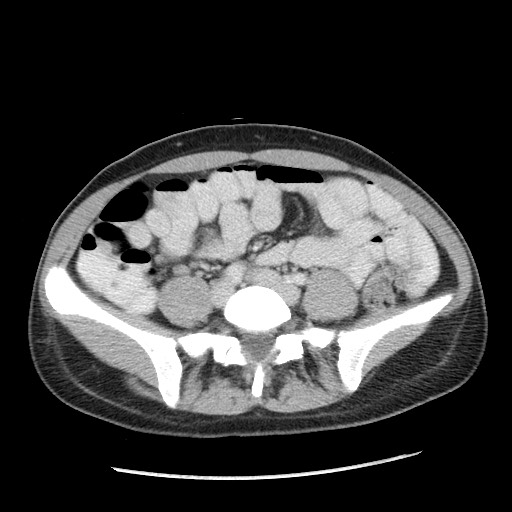 Castleman disease with fibrous pseudotumor in the abdomen (Radiopaedia 77296-89373 A 82).jpg