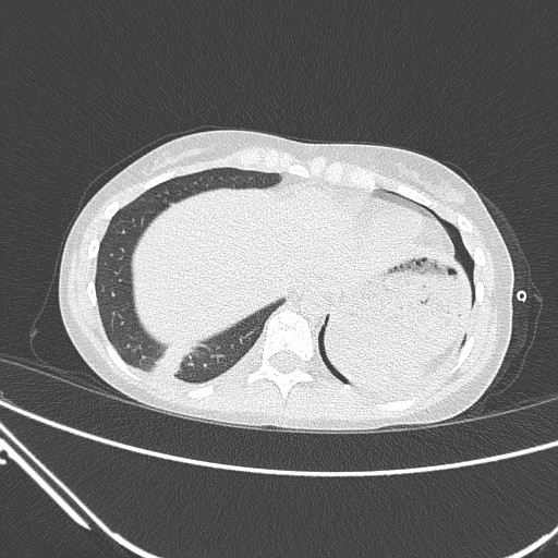 Catamenial pneumothorax (Radiopaedia 27946-28197 lung window 133).jpg