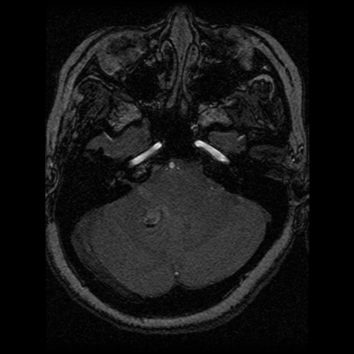 Cavernoma, DVA and right ICA aneurysm (Radiopaedia 33890-35072 E 82).png