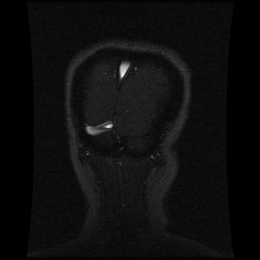 File:Cavernoma with developmental venous anomaly (Radiopaedia 22470-22507 MRV 29).jpg