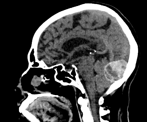 Cavernous hemangioma of the cerebellar falx (Radiopaedia 73025-83723 B 169).jpg
