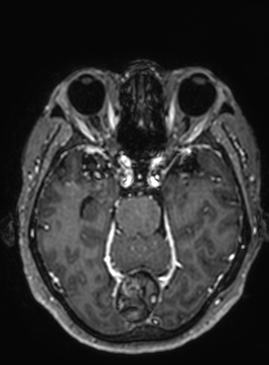 Cavernous hemangioma of the cerebellar falx (Radiopaedia 73025-83724 Axial T1 C+ 215).jpg