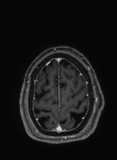 Cavernous hemangioma of the cerebellar falx (Radiopaedia 73025-83724 Axial T1 C+ 53).jpg