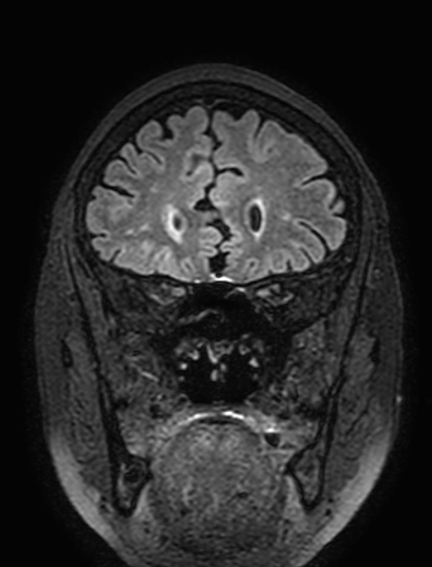 Cavernous hemangioma of the cerebellar falx (Radiopaedia 73025-83724 Coronal FLAIR 90).jpg