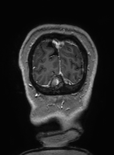 Cavernous hemangioma of the cerebellar falx (Radiopaedia 73025-83724 Coronal T1 C+ 350).jpg