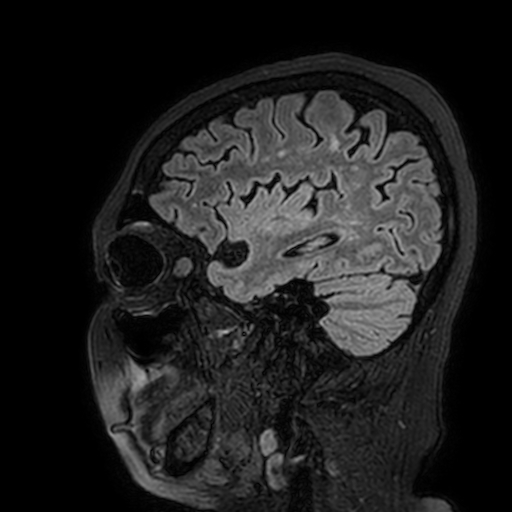 Cavernous hemangioma of the cerebellar falx (Radiopaedia 73025-83724 Sagittal FLAIR 45).jpg