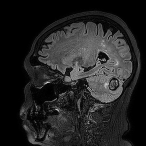 Cavernous hemangioma of the cerebellar falx (Radiopaedia 73025-83724 Sagittal FLAIR 69).jpg