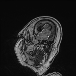 File:Cavernous sinus meningioma (Radiopaedia 63682-72367 Sagittal T1 C+ 31).jpg
