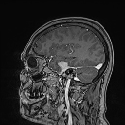 Cavernous sinus meningioma (Radiopaedia 63682-72367 Sagittal T1 C+ 58).jpg