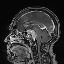 Cavernous sinus meningioma (Radiopaedia 63682-72367 Sagittal T1 C+ 92).jpg
