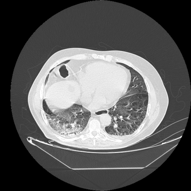 Cavitating bronchogenic carcinoma (Radiopaedia 44489-48162 Axial lung window 59).jpg