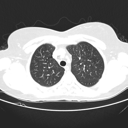 File:Cavitating lung mass - squamous cell carcinoma (Radiopaedia 48047-52854 Axial lung window 13).png