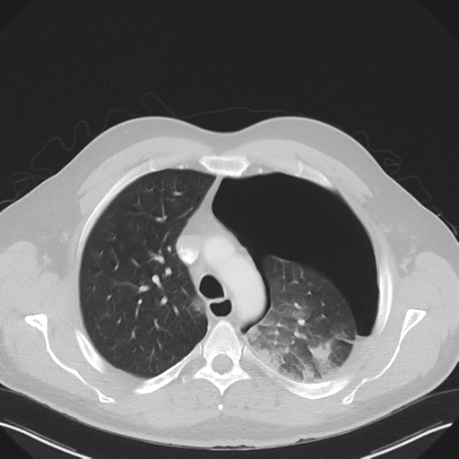 File:Cavitating pneumonia complicated by pneumothorax (Radiopaedia 48149-52994 Axial lung window 20).png