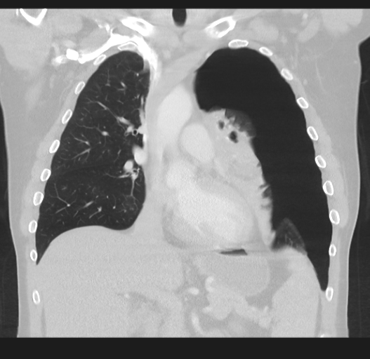 File:Cavitating pneumonia complicated by pneumothorax (Radiopaedia 48149-52994 Coronal lung window 26).png