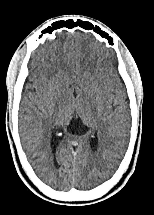 Cavum septum pellucidum and cavum vergae (Radiopaedia 77797-90060 Axial Brain Window 52).jpg
