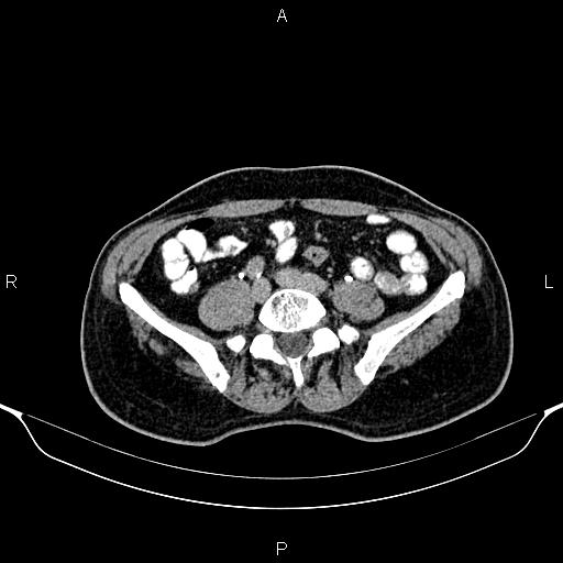 Cecal adenocarcinoma (Radiopaedia 85324-100916 Axial C+ delayed 66).jpg