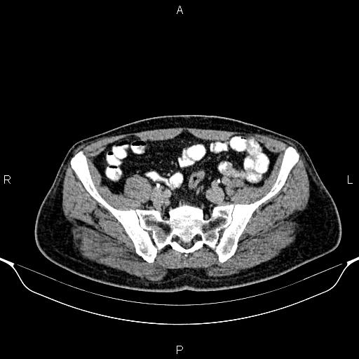 Cecal adenocarcinoma (Radiopaedia 85324-100916 Axial C+ delayed 75).jpg
