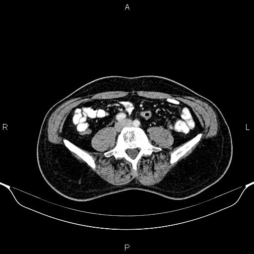 Cecal adenocarcinoma (Radiopaedia 85324-100916 B 62).jpg