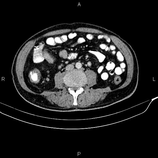 File:Cecal cancer with appendiceal mucocele (Radiopaedia 91080-108651 B 60).jpg