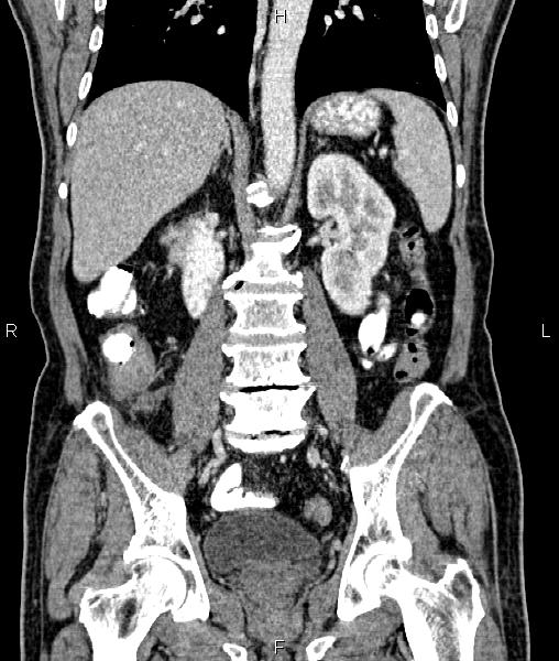 Cecal cancer with appendiceal mucocele (Radiopaedia 91080-108651 D 46).jpg