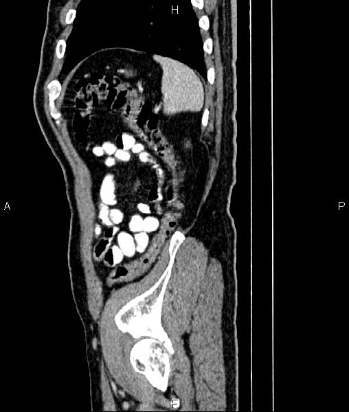 File:Cecal cancer with appendiceal mucocele (Radiopaedia 91080-108651 E 82).jpg