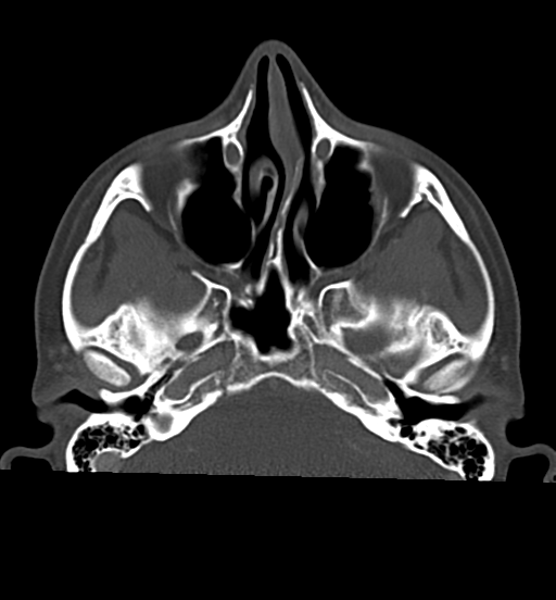 Cemento-ossifying fibroma (Radiopaedia 46243-50643 Axial bone window 23).png