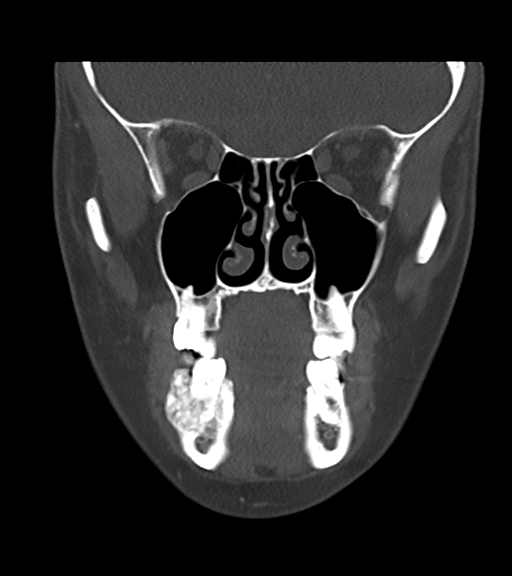 File:Cemento-ossifying fibroma (Radiopaedia 46243-50643 Coronal bone window 22).png