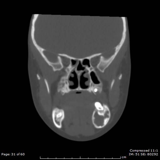 File:Central giant cell granuloma (Radiopaedia 45612-49754 Coronal bone window 31).jpg