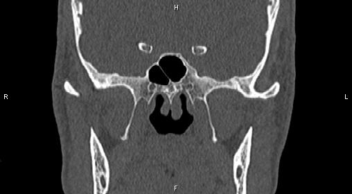 Central giant cell granuloma (Radiopaedia 83346-97761 Coronal bone window 23).jpg