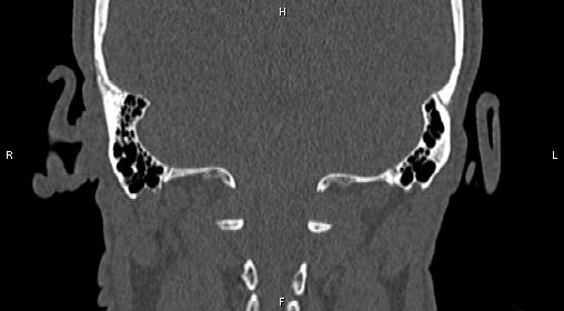 Central giant cell granuloma (Radiopaedia 83346-97761 Coronal bone window 40).jpg