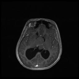 Central neurocytoma (Radiopaedia 30220-30842 Axial T1 C+ 80).jpg