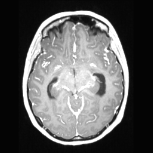 File:Central neurocytoma (Radiopaedia 37664-39557 Axial T1 C+ 35).png