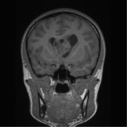 Central neurocytoma (Radiopaedia 37664-39557 Coronal T1 57).png