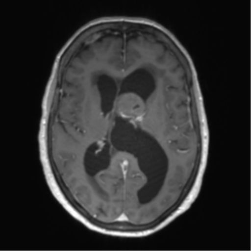 Central neurocytoma (Radiopaedia 65317-74345 Axial T1 C+ 30).png