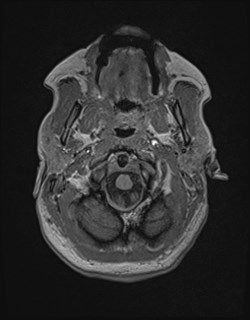 Central neurocytoma (Radiopaedia 84497-99872 Axial T1 27).jpg