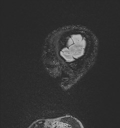 Central neurocytoma (Radiopaedia 84497-99872 Sagittal Flair + Gd 19).jpg