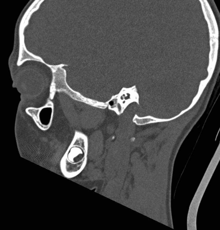 Cerebellar abscess (Radiopaedia 73727-84527 Sagittal bone window 10).jpg