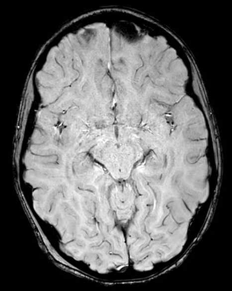 Cerebellar abscess (Radiopaedia 73727-84563 Axial SWI 32).jpg