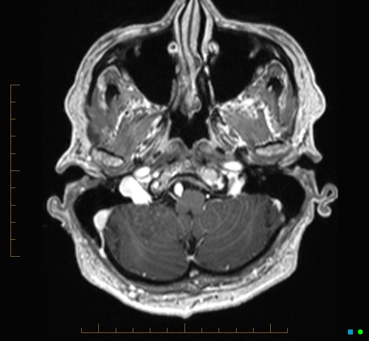 Cerebellar gangliocytoma (Radiopaedia 65377-74422 Axial T1 C+ 11).jpg