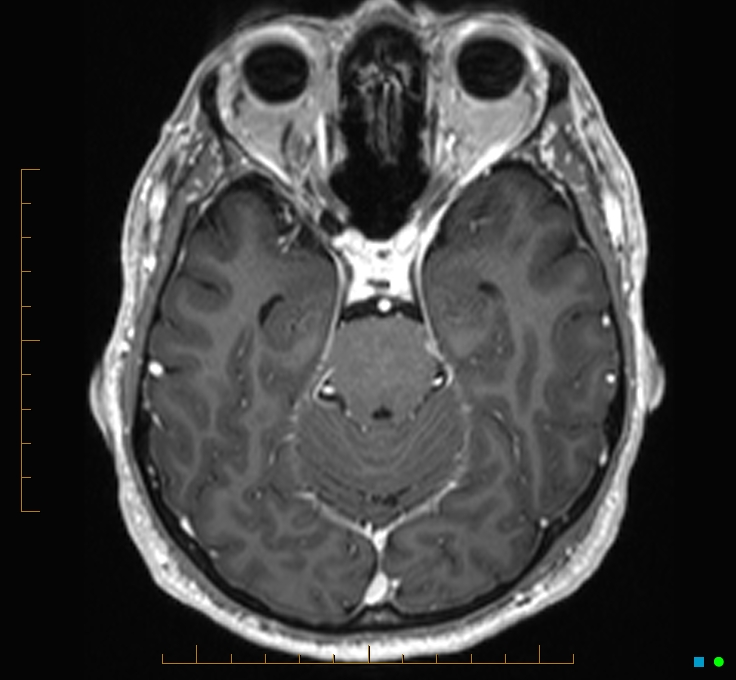 Cerebellar gangliocytoma (Radiopaedia 65377-74422 Axial T1 C+ 42).jpg