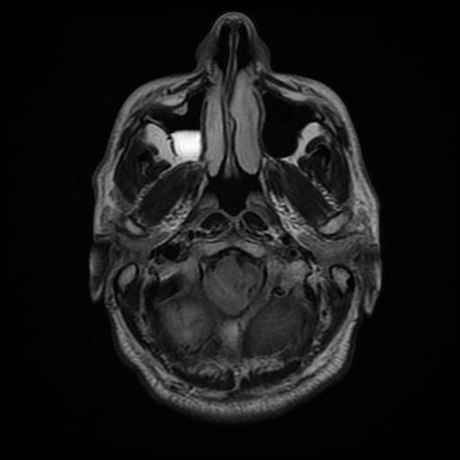 File:Cerebellar hemangioblastoma (Radiopaedia 88055-104622 Axial FLAIR 6).jpg