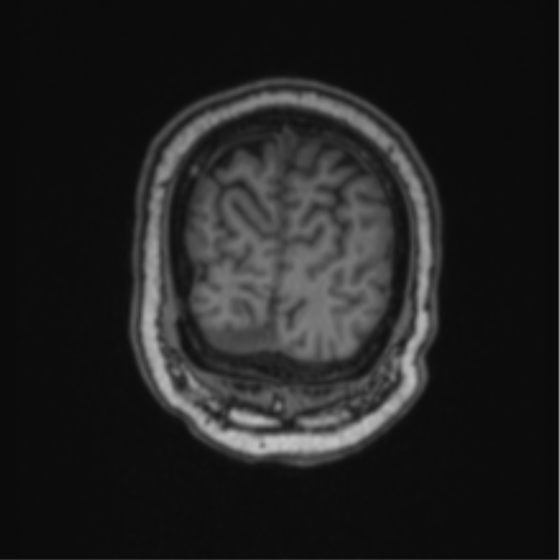 File:Cerebellar hemangioblastomas and pituitary adenoma (Radiopaedia 85490-101176 Coronal T1 16).png