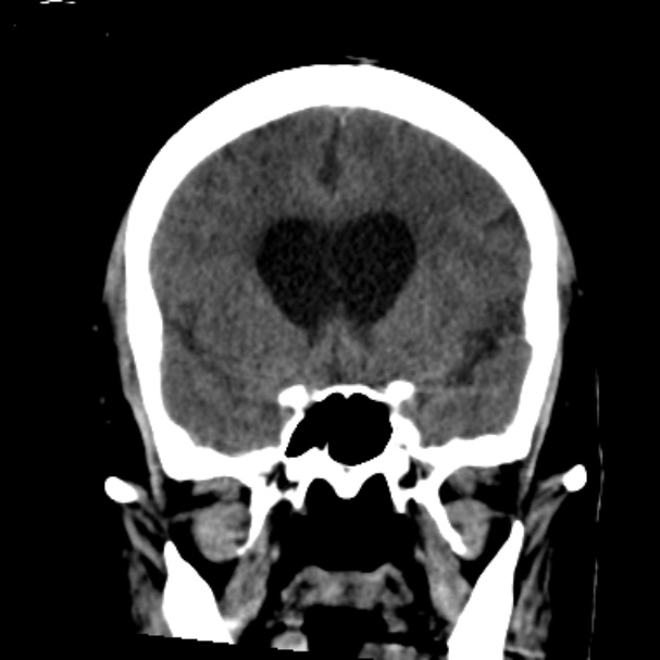 Cerebellar hemorrhage causing obstructive hydrocephalus (Radiopaedia 33989-35207 Coronal non-contrast 21).jpg