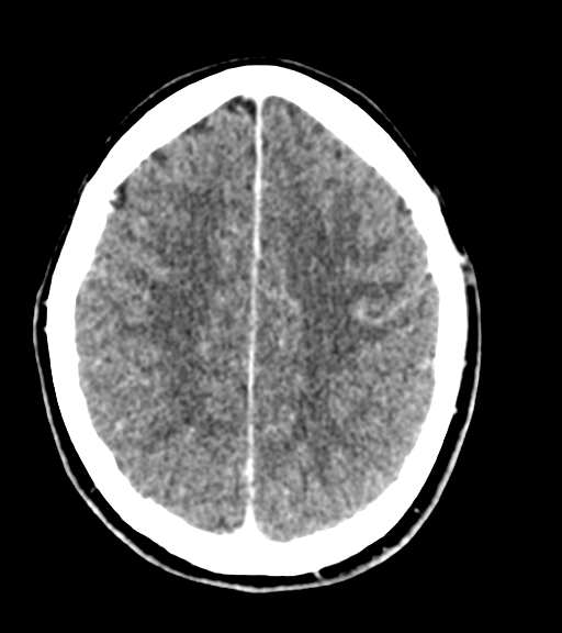 Cerebellar metastases - colorectal adenocarcinoma (Radiopaedia 40947-43652 Axial C+ 46).png