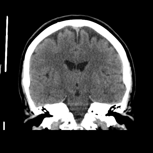 File:Cerebellar metastasis (cystic appearance) (Radiopaedia 41395-44258 Coronal non-contrast 34).png