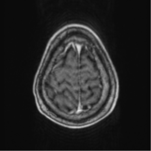 File:Cerebellar metastasis from lung adenocarcinoma (Radiopaedia 86690-102829 Axial T1 C+ 70).png