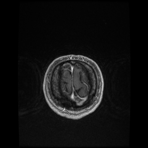 Cerebellar metastasis of pulmonary adenocarcinoma, cavernous venous malformation, and developmental venous anomaly (Radiopaedia 85827-101661 Axial T1 C+ 84).jpg