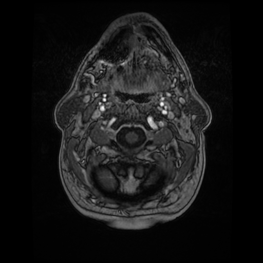 Cerebellar metastasis of pulmonary adenocarcinoma, cavernous venous malformation, and developmental venous anomaly (Radiopaedia 85827-101661 Axial T1 C+ 9).jpg